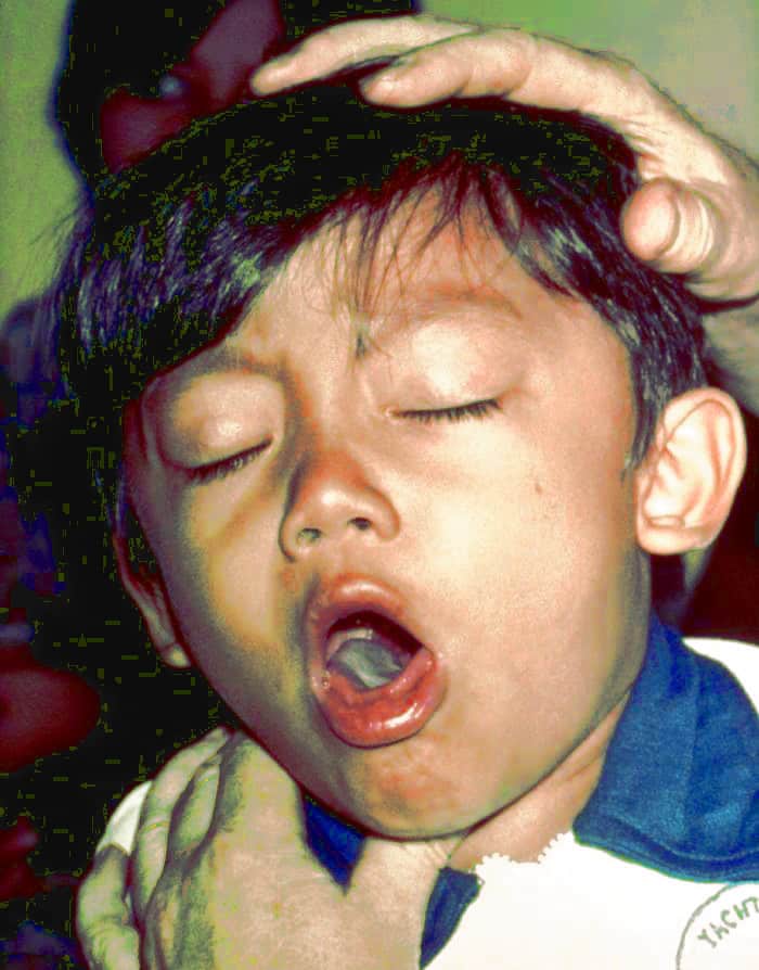 Whooping cough